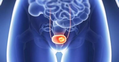 كيفية تشخيص سرطان المثانة؟ كيفية تشخيص سرطان المثانة؟