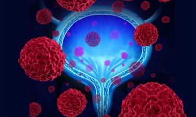 Mesane Kanseri Tedavisi