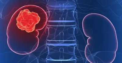 Kidney Cancer Symptoms Kidney Cancer Symptoms