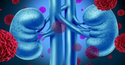Kidney Cancer Symptoms Kidney Cancer Symptoms