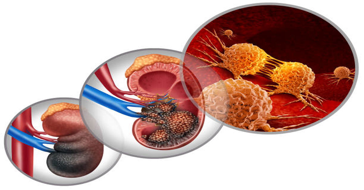 Kidney Cancer Symptoms