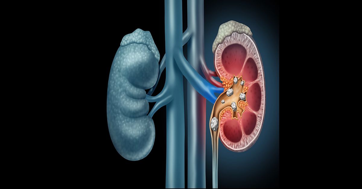 Что вызывает камни в почках?