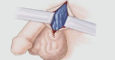 ما هو مرض دوالي الخصية؟ ما هو مرض دوالي الخصية؟