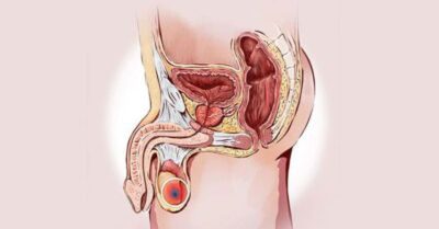 Testis Kanseri Ameliyatı Testis Kanseri Ameliyatı