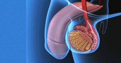 Testis Kanseri Ameliyatı Testis Kanseri Ameliyatı