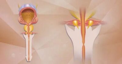 ما هو تضيق مجرى البول؟ ما هو تضيق مجرى البول؟