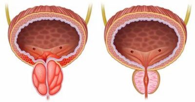 ما هو تضيق مجرى البول؟ ما هو تضيق مجرى البول؟