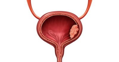 Мочевой конкремент Мочевой конкремент