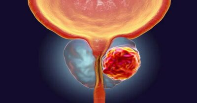 سرطان البروستاتا لدى الشباب سرطان البروستاتا لدى الشباب