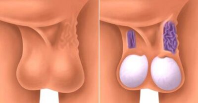 Testis Enfeksiyonu Testis Enfeksiyonu