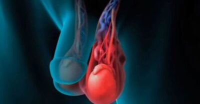 Testis İltihaplanması Testis İltihaplanması