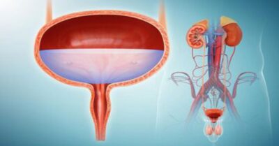 Mesane Yırtılması Mesane Yırtılması