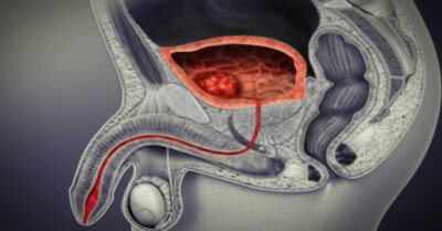 Mesane Yırtılması Mesane Yırtılması