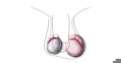 Penis Enfeksiyonu Penis Enfeksiyonu